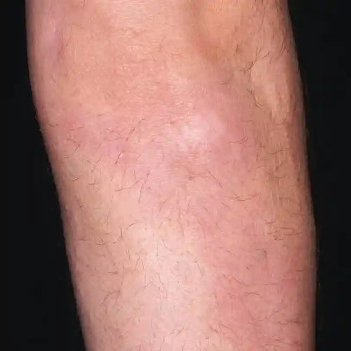 Focused Plaque Treatment