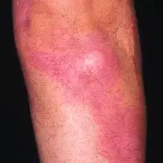 Focused Plaque Treatment