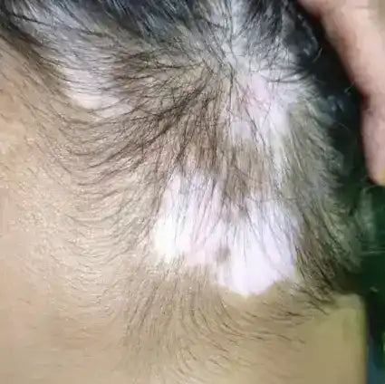 Localized vitiligo patch
