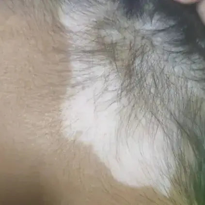 Localized vitiligo patch