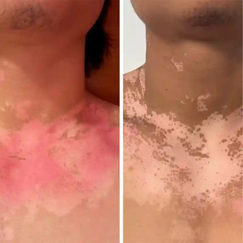 308nm-phototherapy-vitiligo-before-after