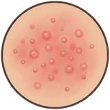 Dermatitis