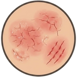 Eczema
