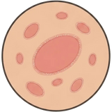 Pityriasis Rosea