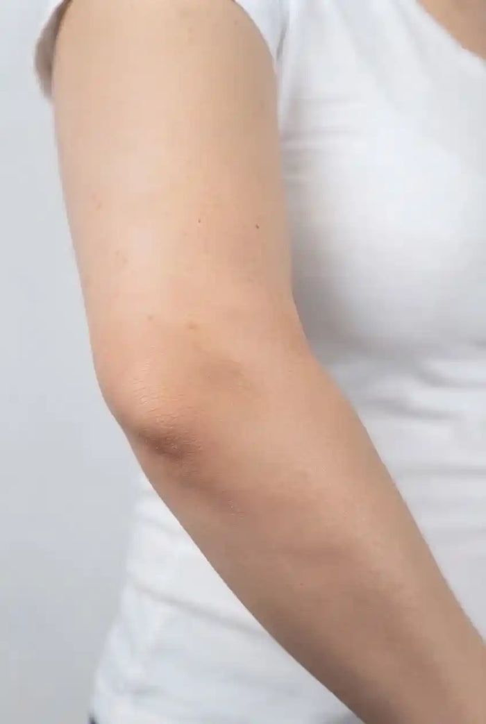 Localized vitiligo patch