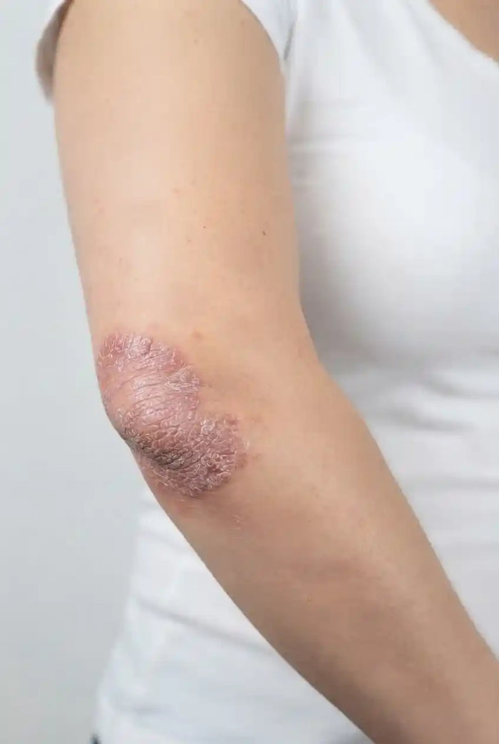 Localized vitiligo patch