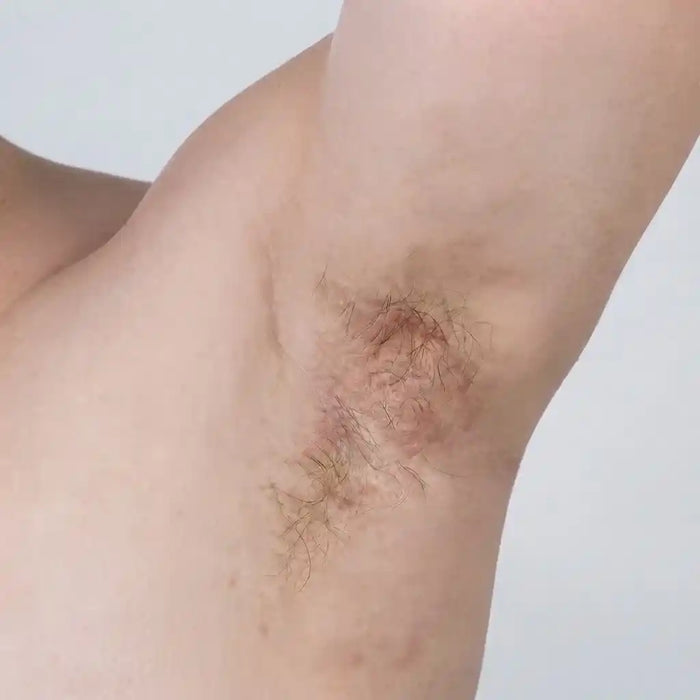 Torso Pityriasis Rosea