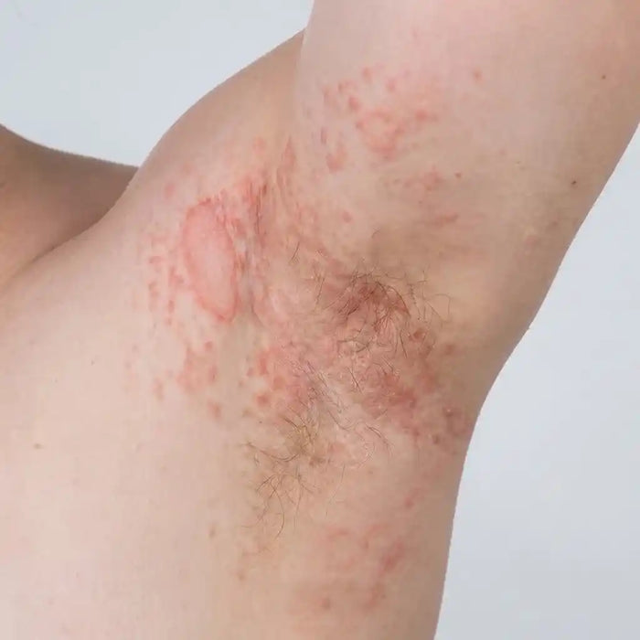 Torso Pityriasis Rosea