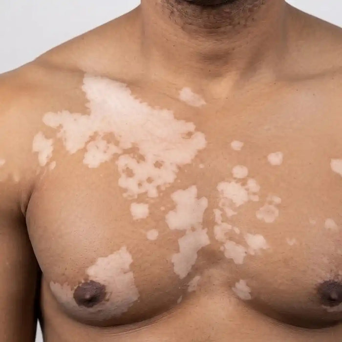 Multi-Spot Vitiligo