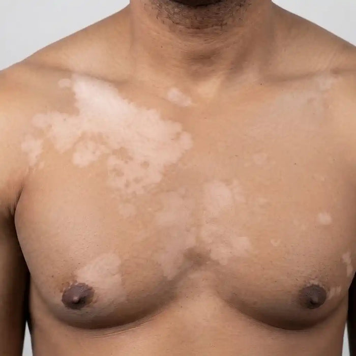 Multi-Spot Vitiligo
