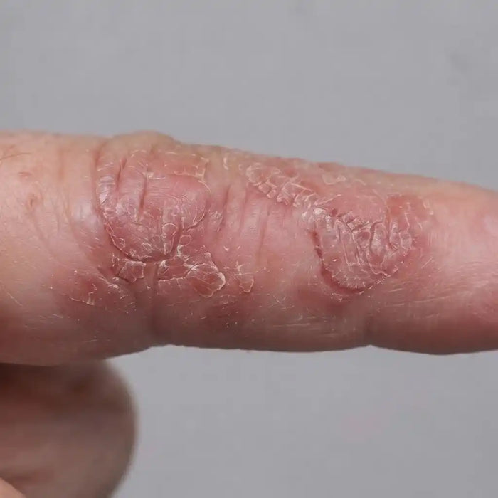 Stubborn Finger Lesions