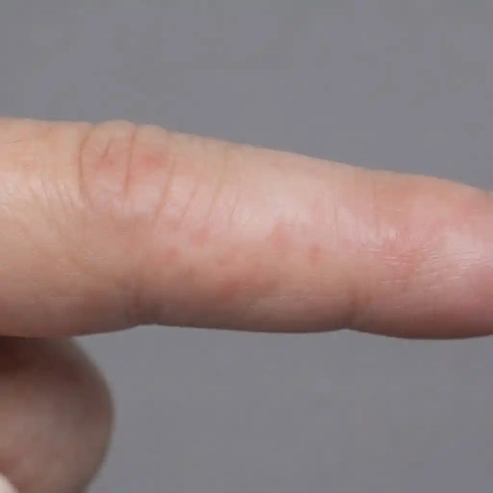 Stubborn Finger Lesions