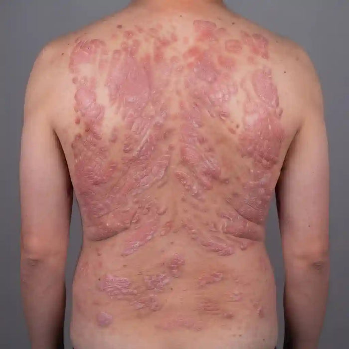 Recalcitrant Psoriasis Plaques