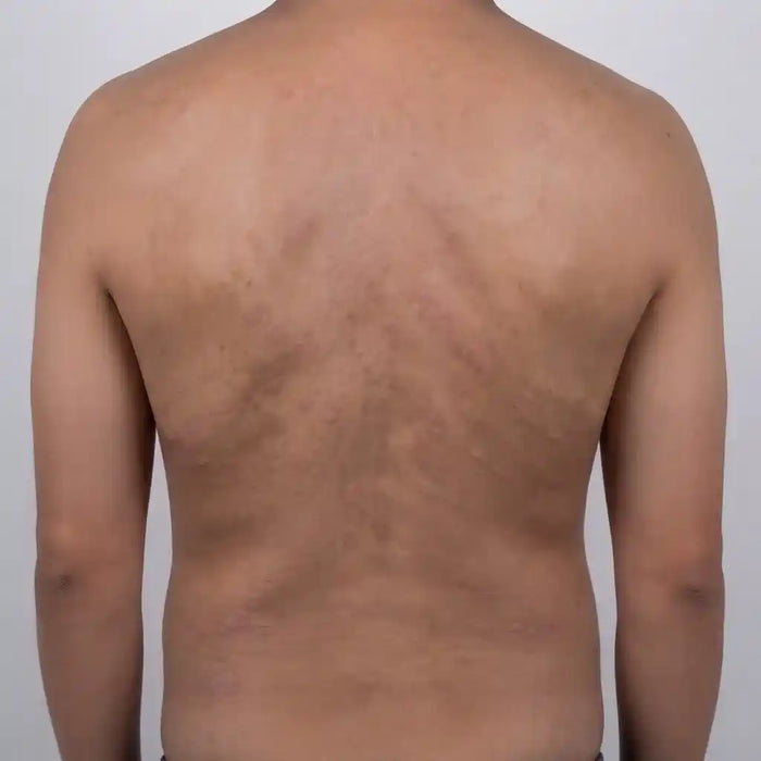 Recalcitrant Psoriasis Plaques
