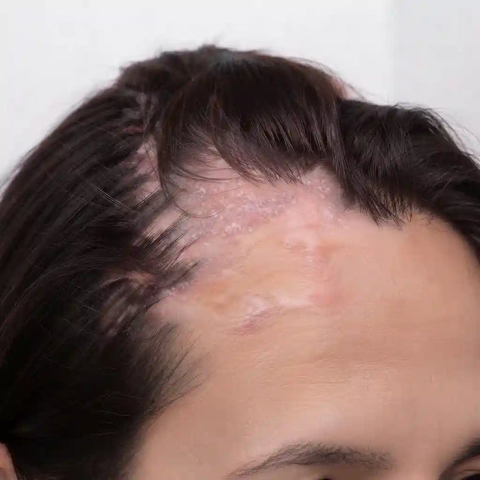 Scalp Seborrheic Dermatitis