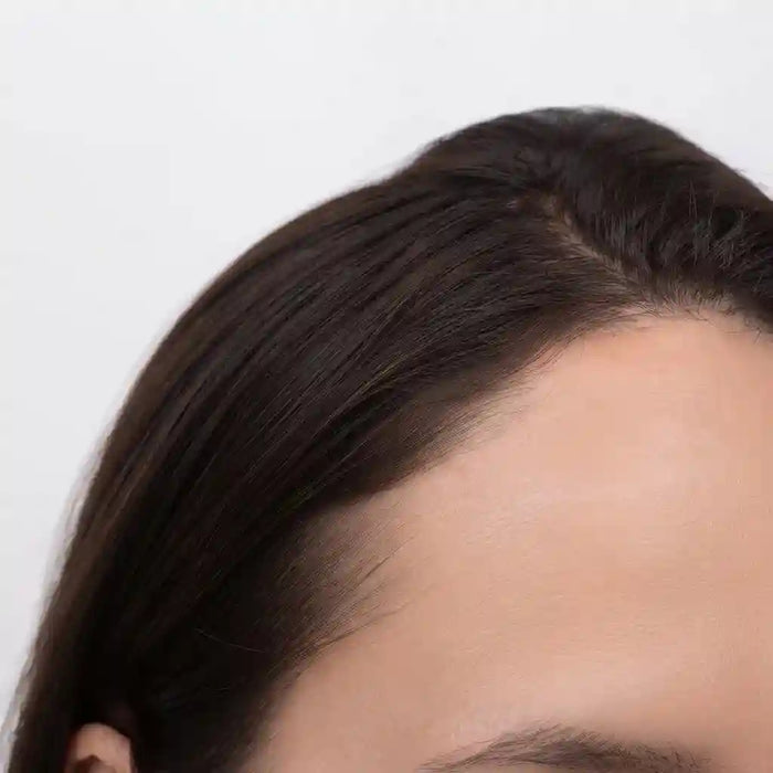 Scalp Seborrheic Dermatitis