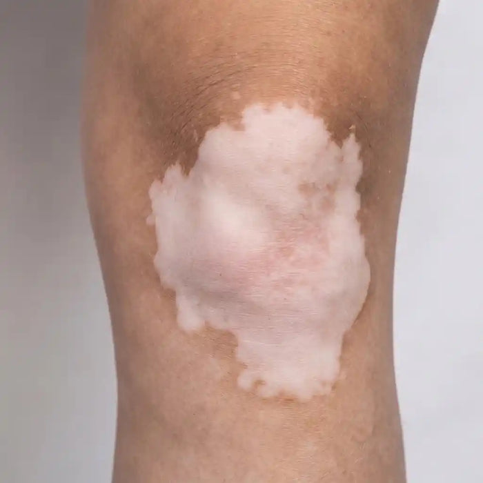 Joint & Flexural Vitiligo