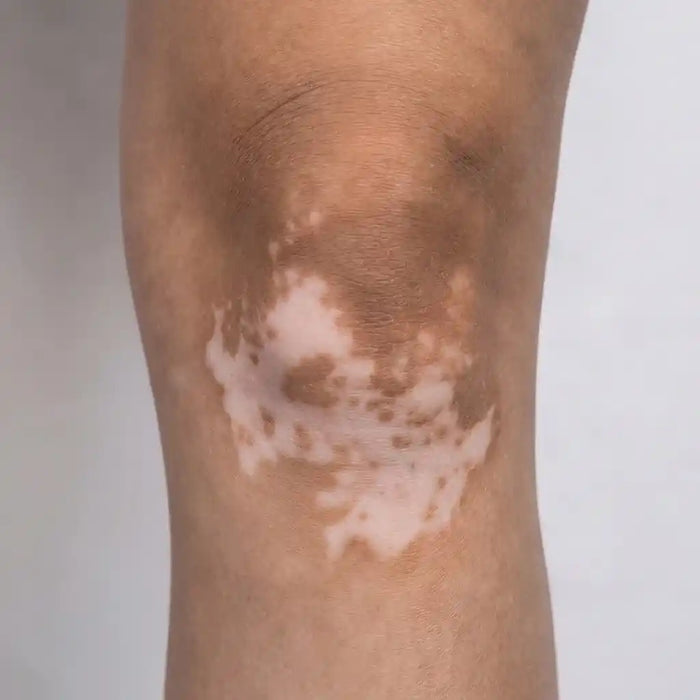 Joint & Flexural Vitiligo
