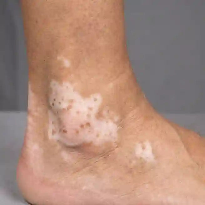 Psoriasis plaques