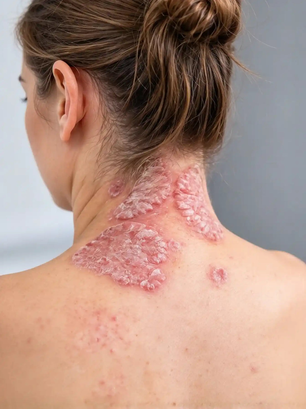 psoriasis-skin-condition