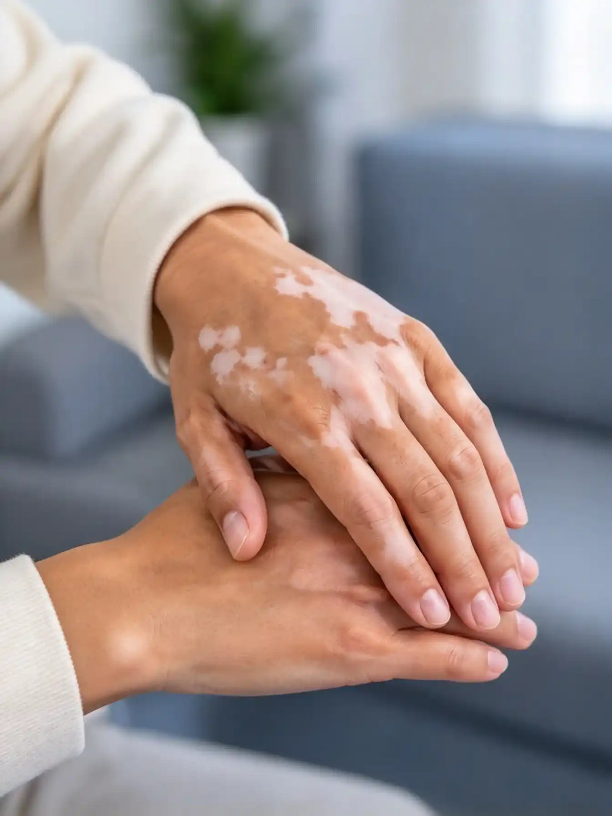 vitiligo-skin-condition
